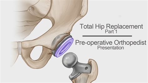 Total Hip Replacement Part 1 Pre Operative Orthopedist Presentation Youtube