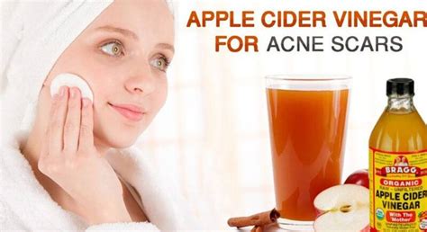 How To Use Apple Cider Vinegar For Acne Scars Ostomy Lifestyle