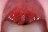 Images of Angina Throat Treatment