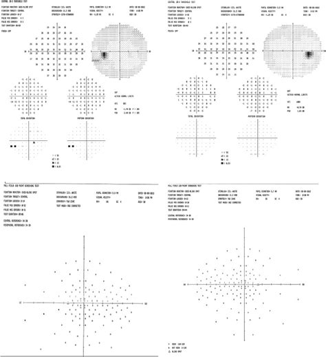 Photopsia And A Temporal Visual Field Defect Survey Of Ophthalmology