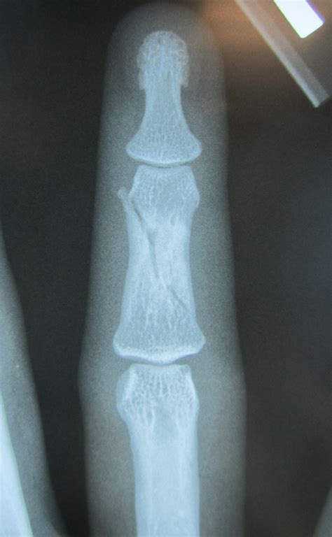 less invasive finger fracture treatment john erickson md