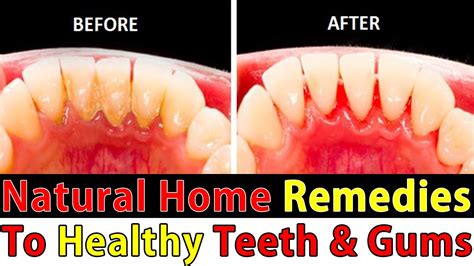 Home Remedies For Healthy Teeth And Gums Naturally