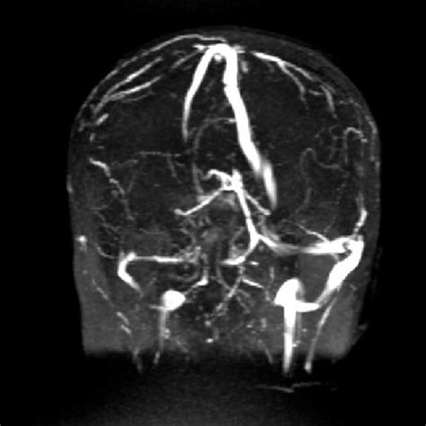 Mrv Shows Normal Appearing Superior Sagittal Sinuses Bilateral