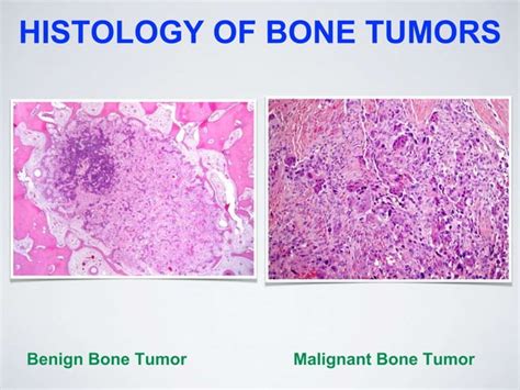 Musculoskeletal Tumors Ppt