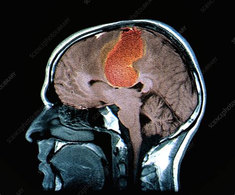 Brain Cancer Mri Stock Image C0472034 Science Photo Library
