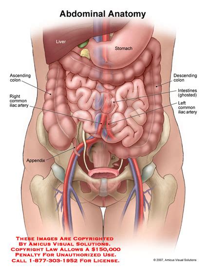 An abdominal aortic aneurysm is a swelling of the largest blood vessel in the body (the aorta) inside the abdomen. (08095_01X) Abdominal Anatomy - Anatomy Exhibits