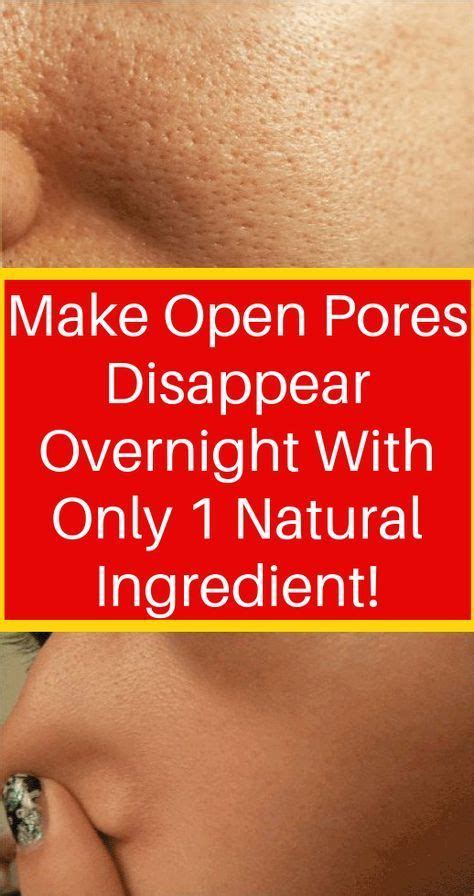 Get Rid Of Open Pores Naturally In Just 3 Days With These Powerful Home Remedies Skin Care