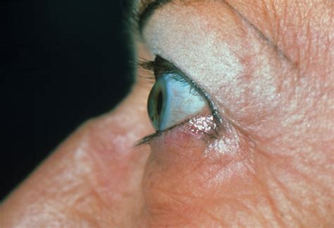 Changes In Meibomian Glands May Signal Thyroid Eye Disease