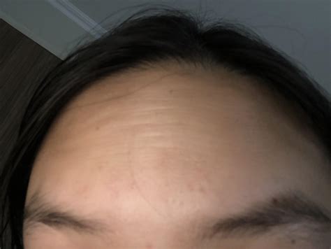 Skin Concerns Forehead Lines In My 20s Visible When You Look Closer