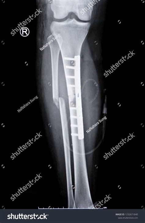 Xray Right Leg Show Fracture Tibia ภาพสต็อก 1232671840 Shutterstock