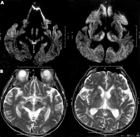 Diffusion Weighted Magnetic Resonance Imaging In A Case Of Acute