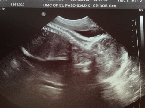 28 Week Ultrasound Twin Motherhood