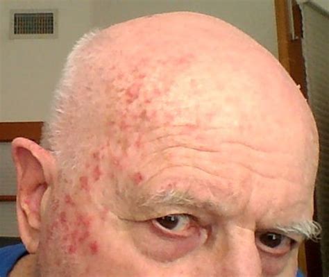 Skin Cancer Destroyed At Home