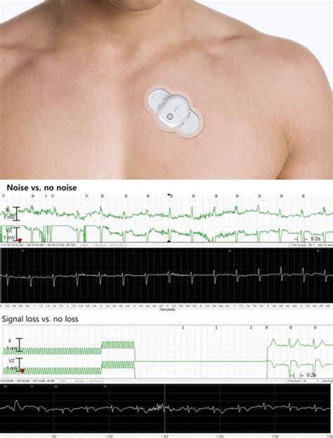 Comparison Of Continuous Ecg Monitoring By Wearable Patch Device And