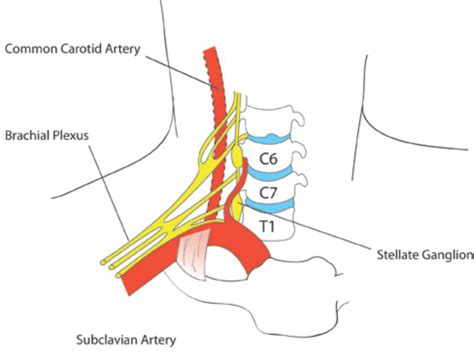 STELLATE GANGLION BLOCK ANAESTHESIA TUTORIAL OF THE WEEK 256 : WFSA