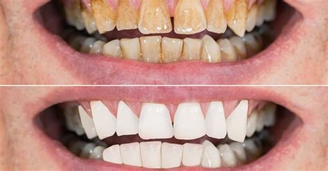 Teeth Discoloration Causes Symptoms Prevention And Cures