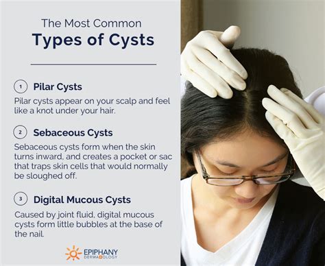 Types Of Cysts Epiphany Dermatology