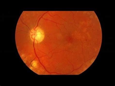 Preretinal fibrosis and tractional retinal detachment. Diabetic Eye Disease - YouTube