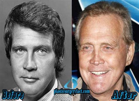 Lee Majors Plastic Surgery Before And After