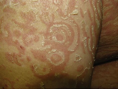 erythema gyratum repens without associated malignancy journal of the american academy of