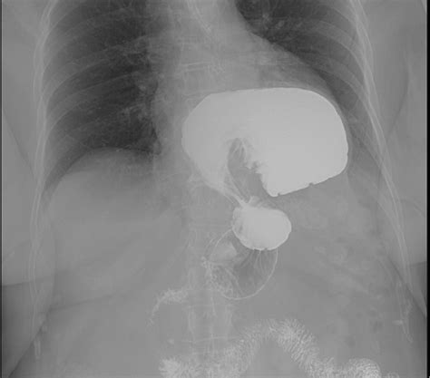 Upper Gi Series Showing A Large Paraesophageal Hernia With Organoaxial