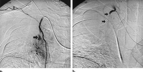 Coil Embolization A Selective Right Internal Mammary Angiogram Shows