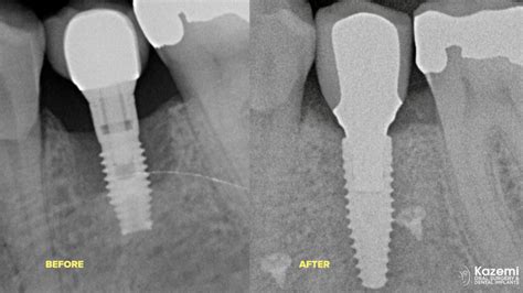 Removal Of A Dental Implant With Advanced Bone Loss Followed By Bone