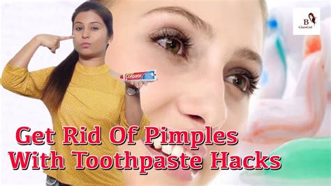 Get Rid Of Pimples With These Awesome Toothpaste Hacks Amazing Toothpaste Beauty Benefits