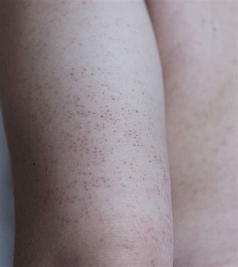 What Causes Keratosis Pilaris In Children And How To Treat It