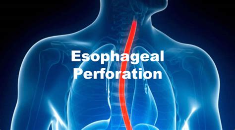 Esophageal Tear Causes Symptoms Diagnosis And Treatment
