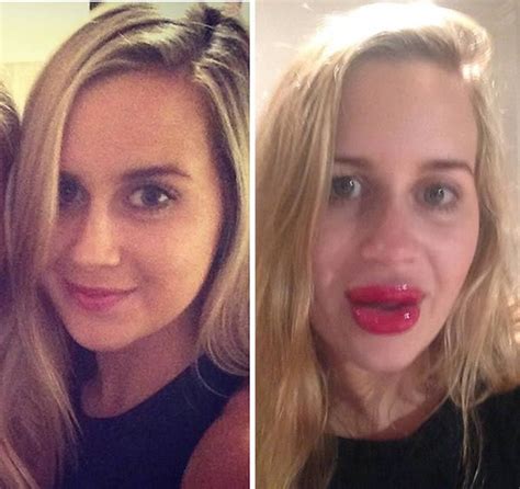 The Woman Left With Atrout Pout After Using Lip Enhancer