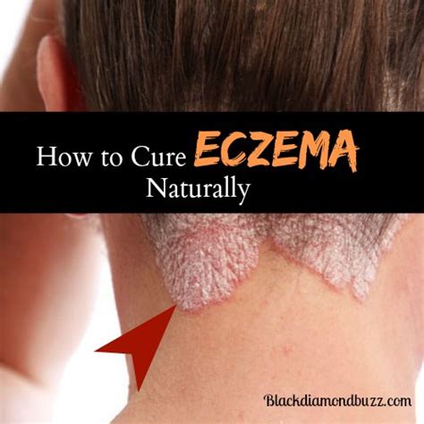 You can read about the beat eczema system by visiting: How to Cure Eczema Permanently - 10 Home Remedies for Eczema