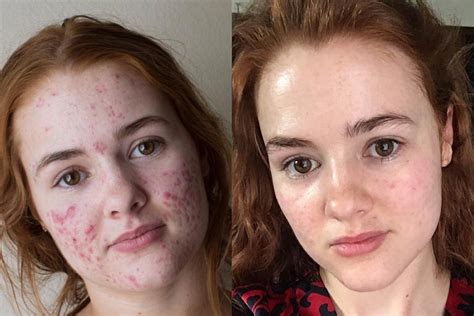 This Woman Documented Her Acne Transformation And The Before And After