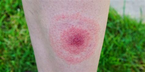 How To Spot And Treat A Tick Bite — And What To Do You If You Have A