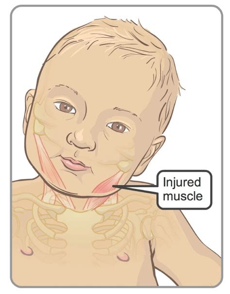 Torticollis Visual Craniosacral Therapy Torticollis Muscles Of The Neck