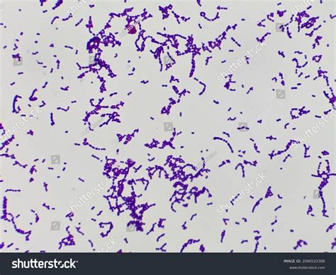 Streptococcus Pyogenes Infected Aged Patient Showing库存照片2090522308