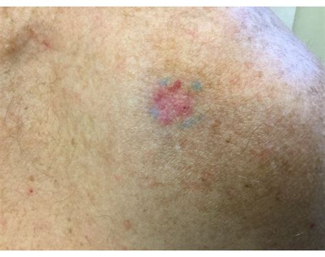 7 Facts You May Not Know About Basal Cell Carcinoma Ren Dermatology