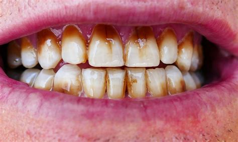 8 Best Ways To Remove Coffee Stains From Teeth Naturally