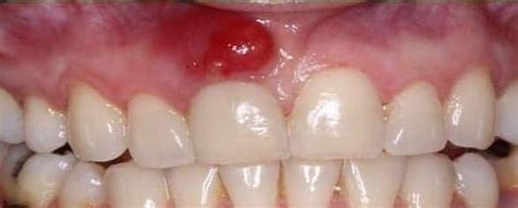 Absceso Periapical ¿puede Ser Grave Abaden Dentistas