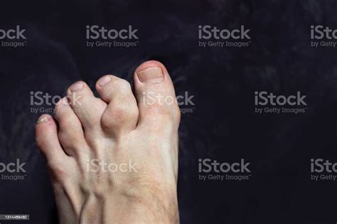 Inflammation And Deformity Of The Toes Gouty Toes Toes Affected By Gout
