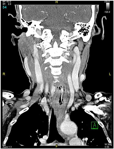 Ct Scan Of Neck With Contrast Showing The Radiopaque Foreign Body