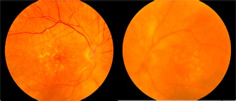 Fundus Examination Fundoscopy Revealed Bilateral Optic Nerve Swelling
