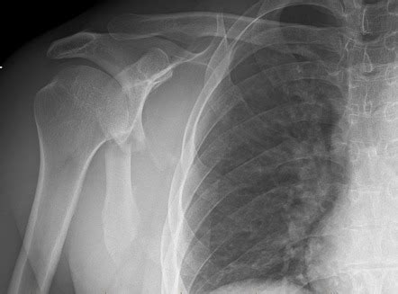 Scapula Fracture Radiology