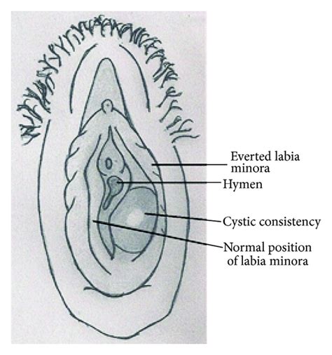 Figure 2 Leiomyoma In Vulva A Diagnostic Dilemma