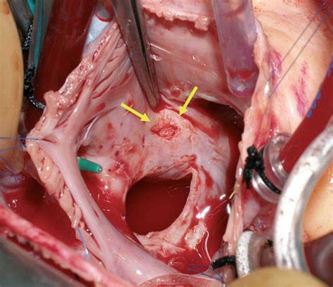 Late Cardiac Perforation After Percutaneous Closure Of An Atrial Septal