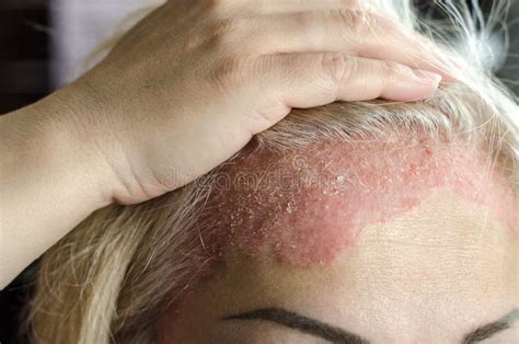 Dermatological Skin Disease Psoriasis Eczema Dermatitis Allergies