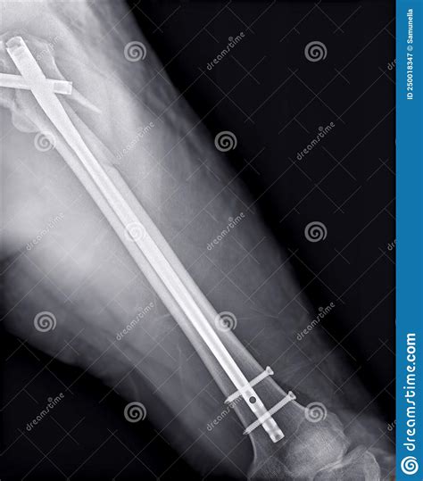 X Ray Femur Bone With Total Hip And Femur Replacement Stock Image