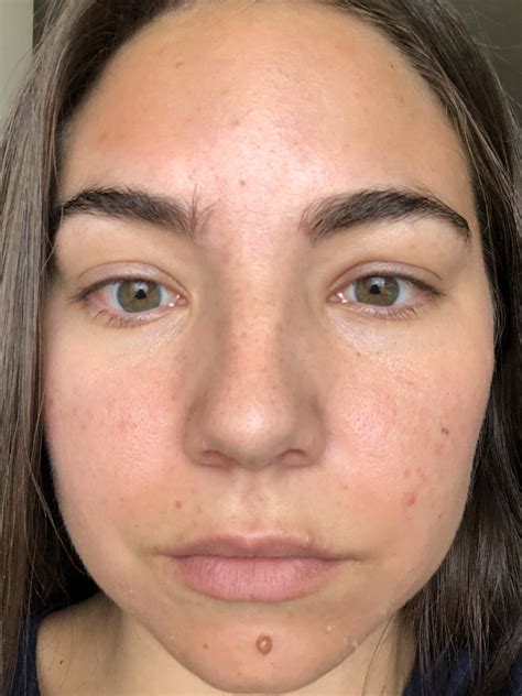 Jessner Chemical Peel Beforeafter Photos Of The Proven Facial