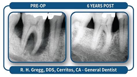 Case Studies Lanap 1 Millennium Dental Technologies Inc