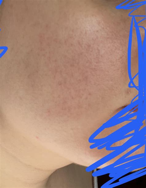 What Are These Red Dots On My Cheek And How Do I Get Rid Of Them R